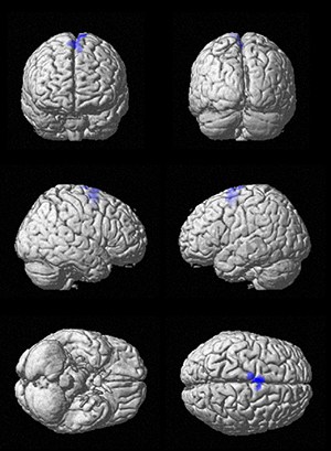 Music Activates Regions of the Brain Spared by Alzheimer’s - Music & Memory